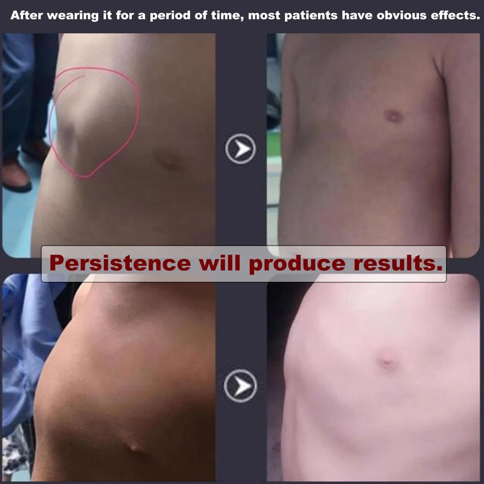 NICHOY Ortezy Pectus Carinatum dla dorosłych: uchwyt na klatkę piersiową gołębicy z regulatorem rozmiaru, szelki z żebrami koślawymi, łatwe w użyciu (regulowany model)