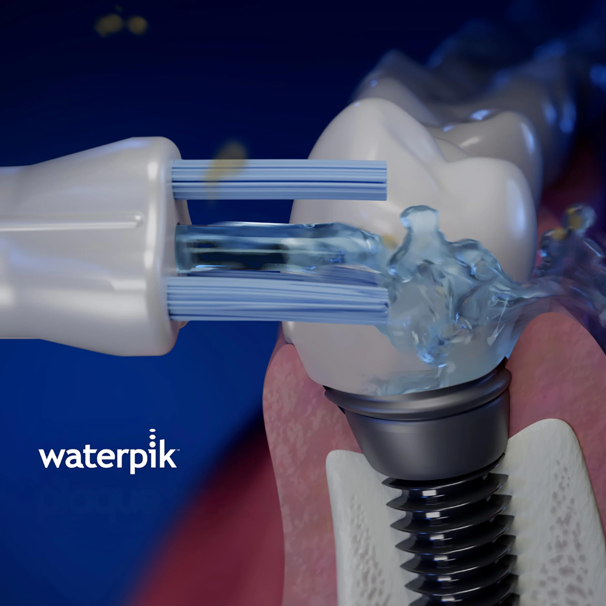 Waterpik Końcówka Plaque Seeker do Irygatora, Wymienna do Implantów, Koron, Mostków, 2 Sztuki PS-100E