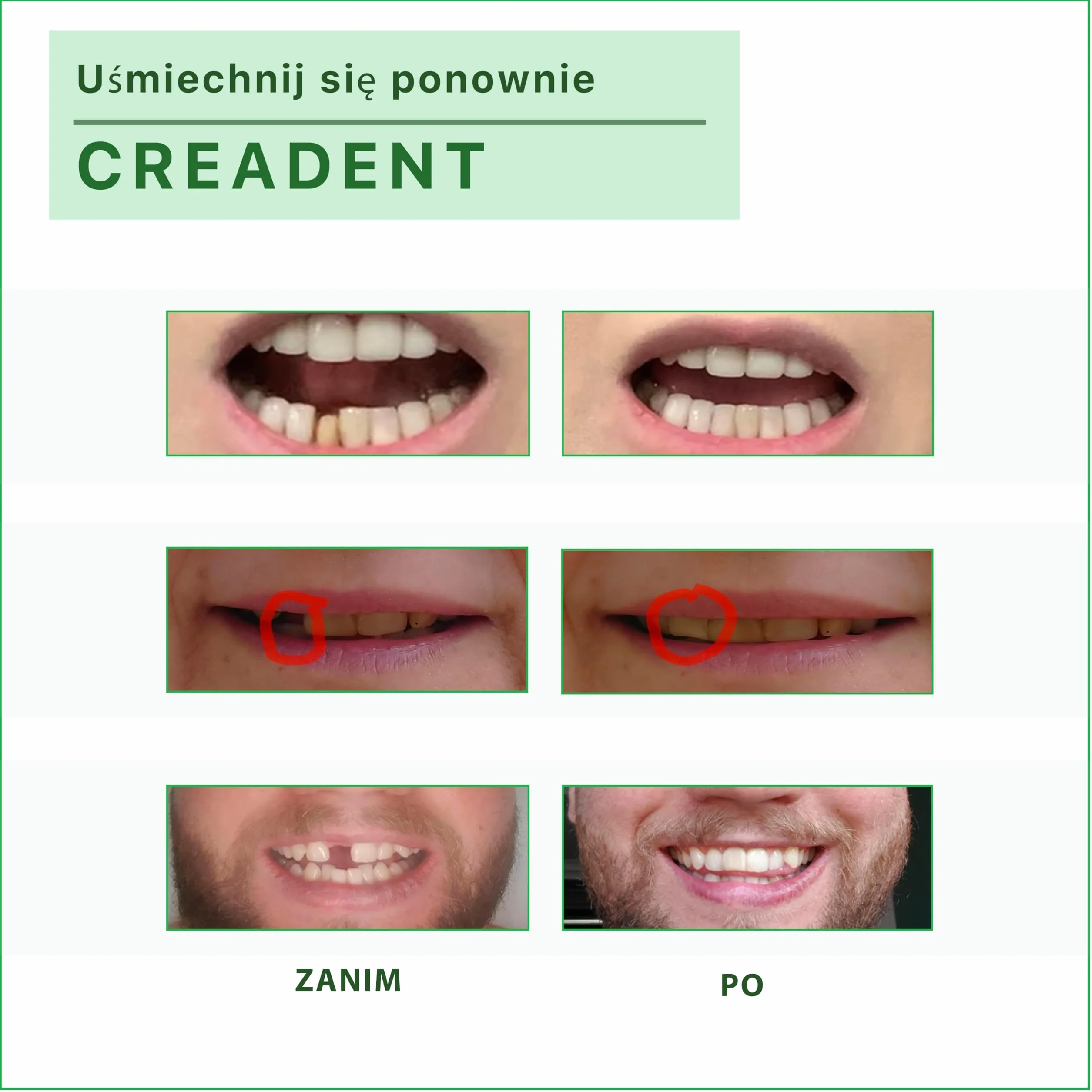 CREADENT - Zestaw do zastąpienia brakującego zęba - Tymczasowy ząb kosmetyczny, aby odzyskać uśmiech