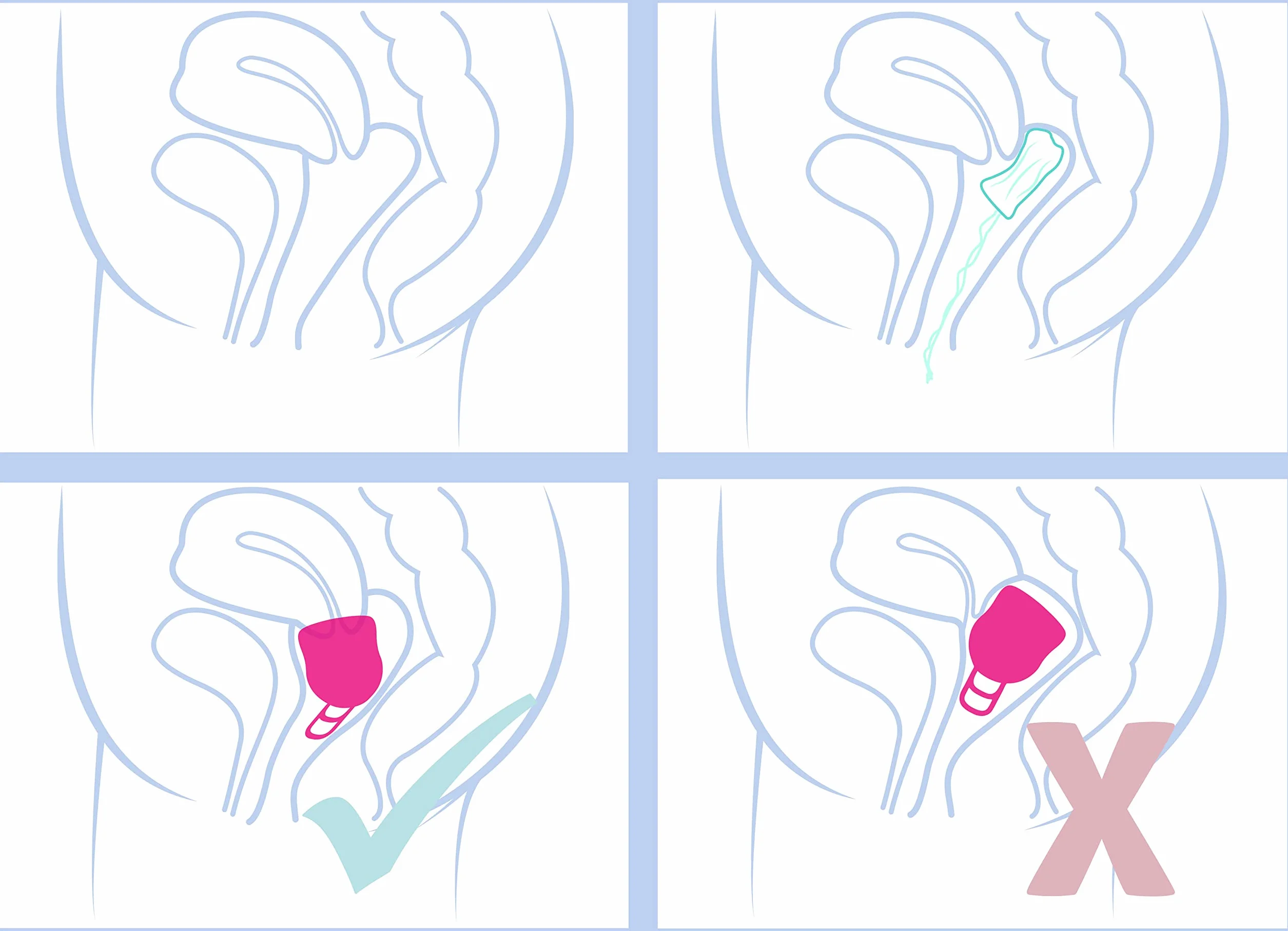 Merula BZ-JDXM-O9V0 Kubek Menstruacyjny, XL, Różowy