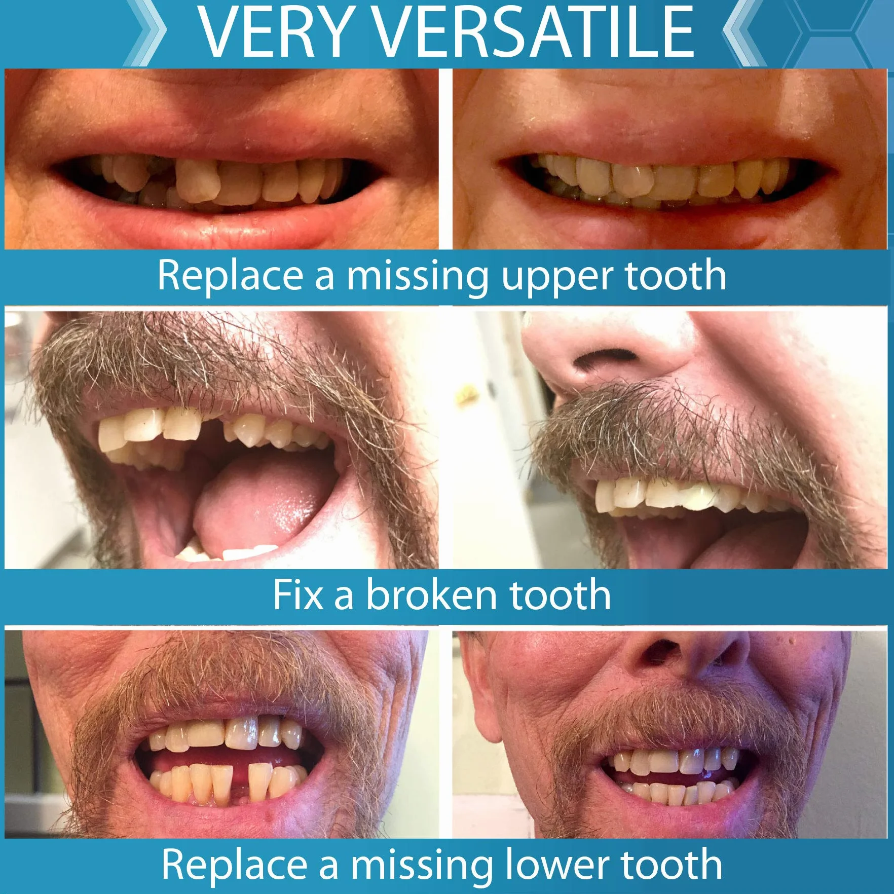 Instant Smile Uzupełnij swój uśmiech, zestaw do tymczasowej wymiany zębów