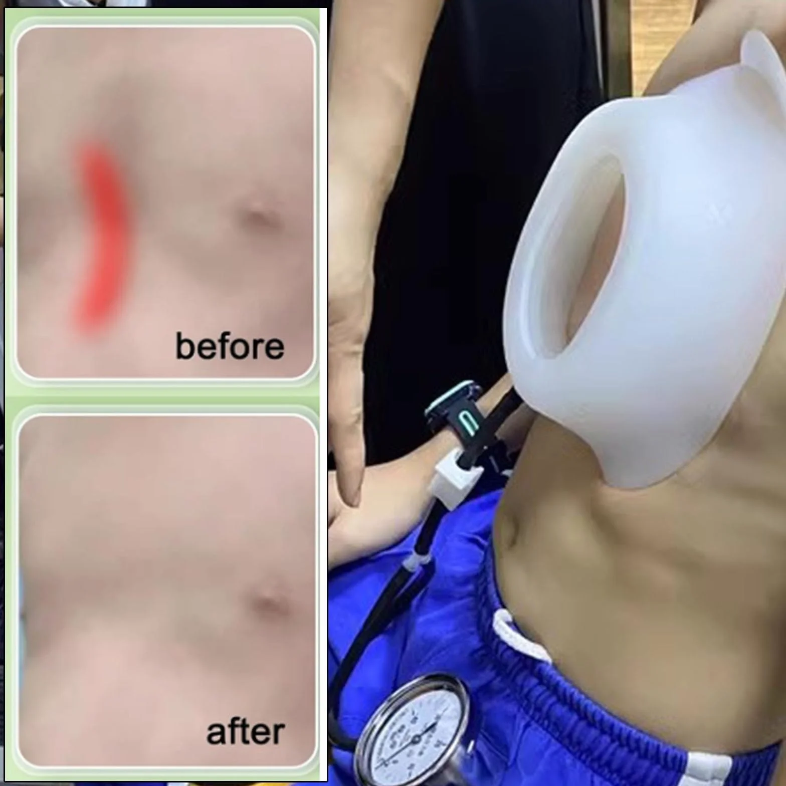 Pectus Excavatum Bańka próżniowa Orteza korekta fizyczna zmywalna monitorowanie ciśnienia S-S