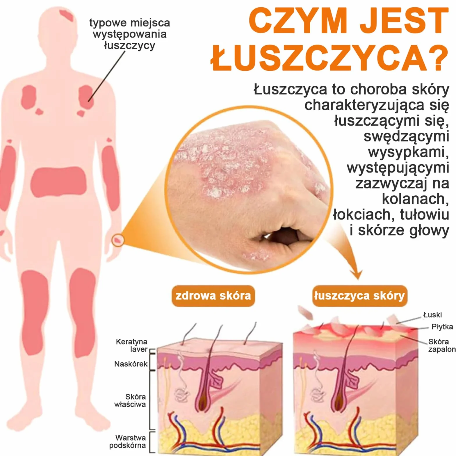 LOVILDS PsoriaHeal Sprayna, Profesjonalny Bee Venom Spray, LOVILDS Bee Venom Psoriasis Spray, Naturalne składniki, dla każdego (4)
