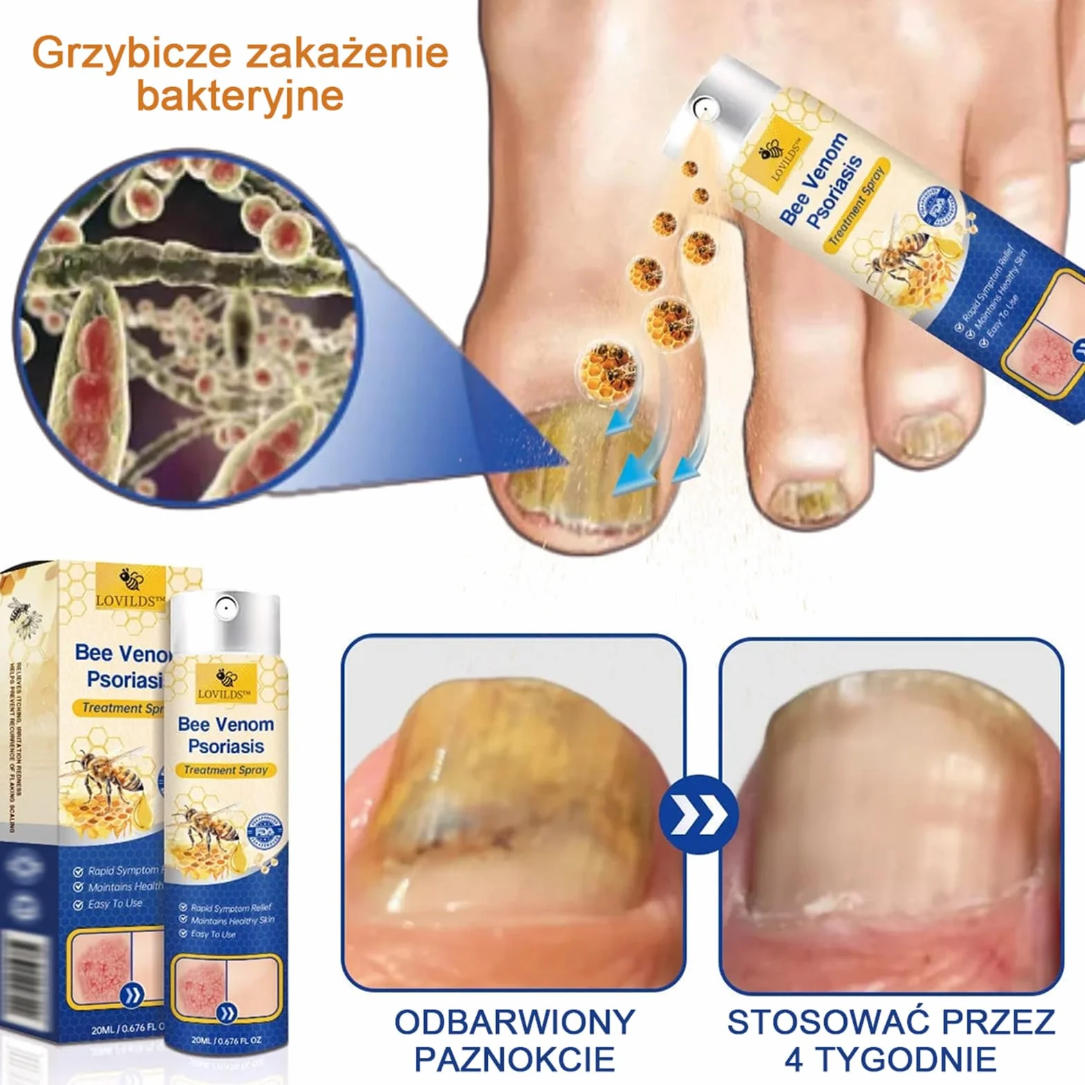 LOVILDS PsoriaHeal Sprayna, Profesjonalny Bee Venom Spray, LOVILDS Bee Venom Psoriasis Spray, Naturalne składniki, dla każdego (4)