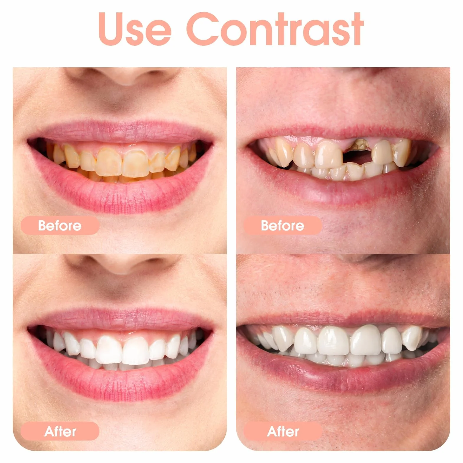 Snap on Perfect Smile Sztuczne Zęby 1 Para Zatrzaskowe Silikonowe Forniry Tymczasowe Wybielanie Proteza Górne Dolne