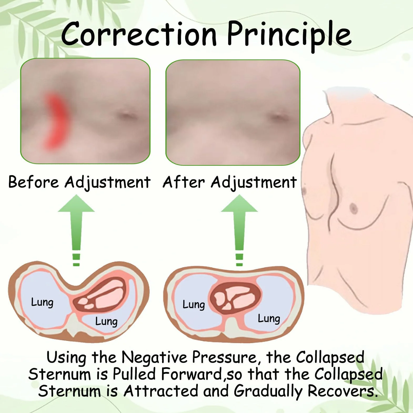 Pectus Excavatum Vacuum Bell, Orteza Na Klatkę Piersiową, Urządzenie Korekcyjne Z Manometrem, Terapia Dzwonem Próżniowym Standard-S