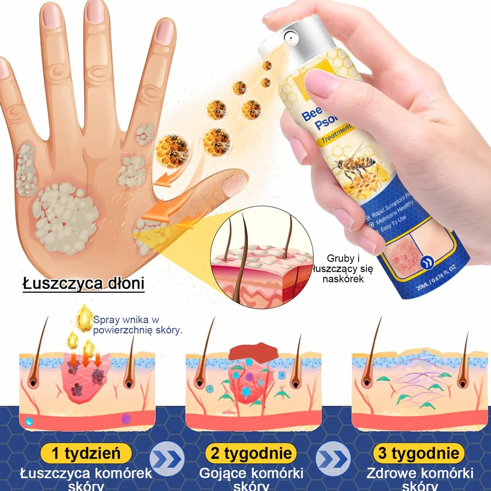 LOVILDS PsoriaHeal Sprayna, Profesjonalny Bee Venom Spray, LOVILDS Bee Venom Psoriasis Spray, Naturalne składniki, dla każdego (4)