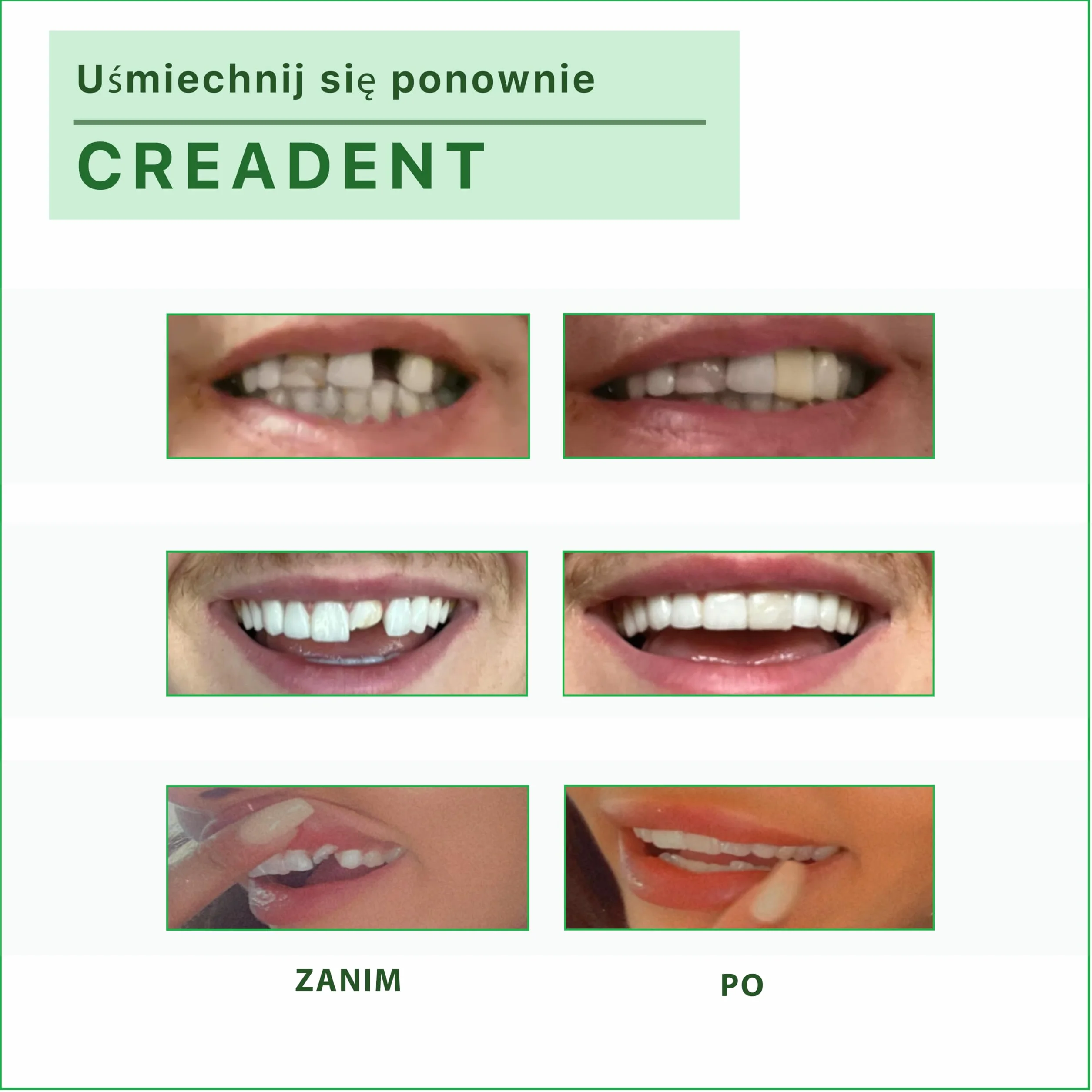CREADENT - Zestaw do zastąpienia brakującego zęba - Tymczasowy ząb kosmetyczny, aby odzyskać uśmiech