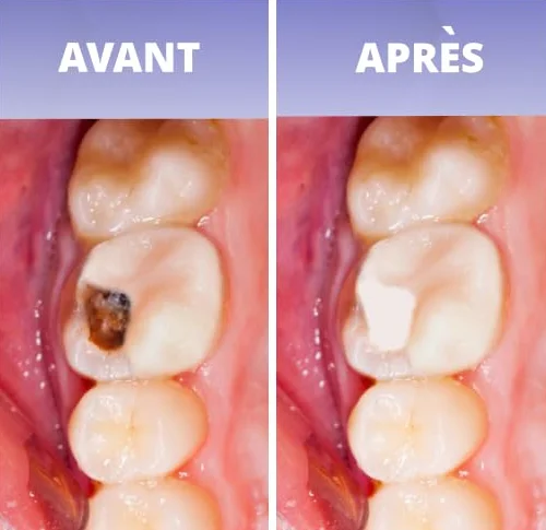 Opatrunek dentystyczny do zatykania próchnicy, wypełnienia dziury, wypełnienia lub amalgamatu. 100% francuska produkcja - gotowa do użycia pasta szybko twardniej; + 30 aplikacji.