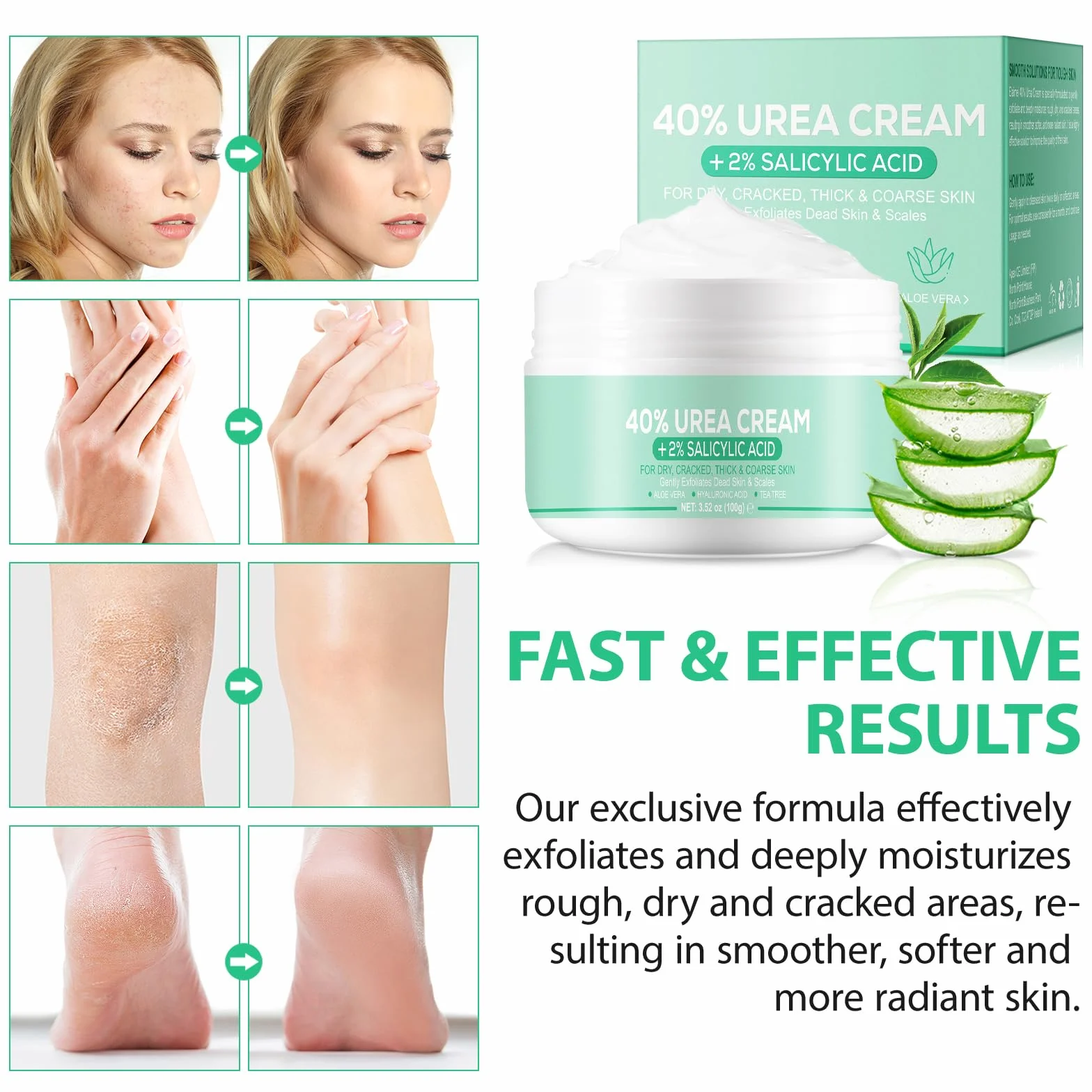 40% Urea Cream, Urea Foot & Hand Cream 3,52 oz do popękanych pięt i suchej skóry, z aloesem, olejkiem z drzewa herbacianego i jojoba do głębokiego nawilżenia, usuwania zrogowaciałego naskórka i