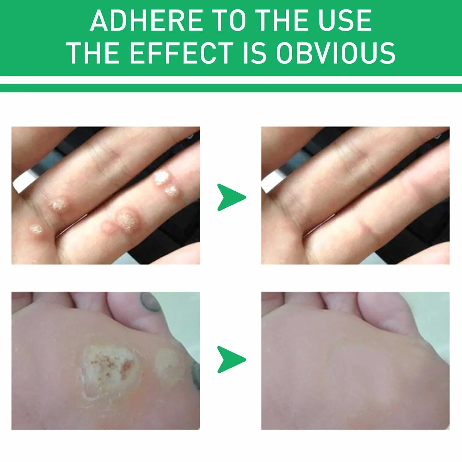 Corn Remover Gel Extra Strength for Feet Toes Hands Care, Wart Remover Liquid (1pcs)