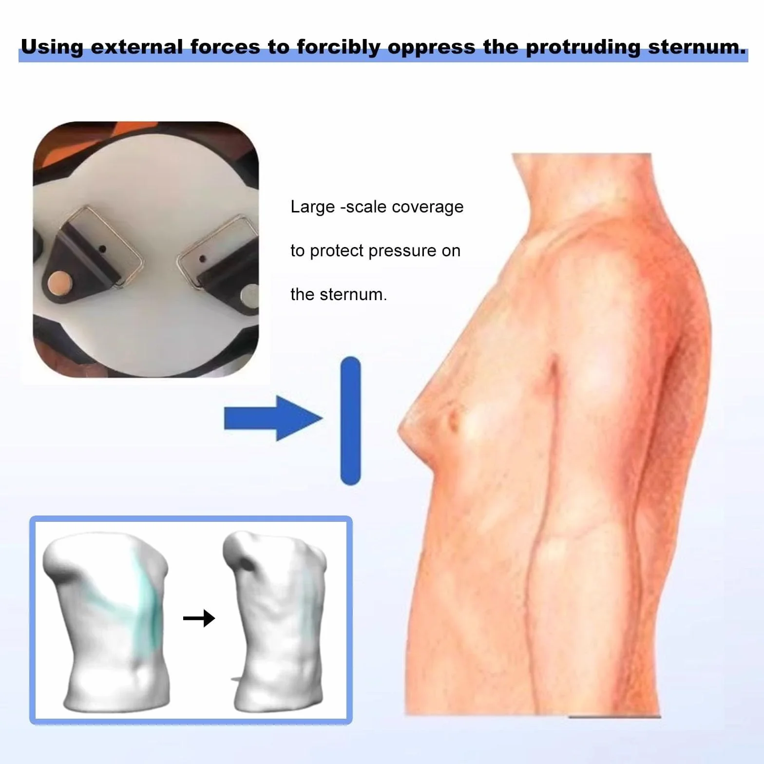 NICHOY Orteza Pectus Carinatum - Orteza na zdeformowany mostek, Podpora klatki piersiowej gołębiej dla wszystkich grup wiekowych, Ortezy koślawego żebra, Regulowany rozmiar, Odpowiednia dla wszystkich