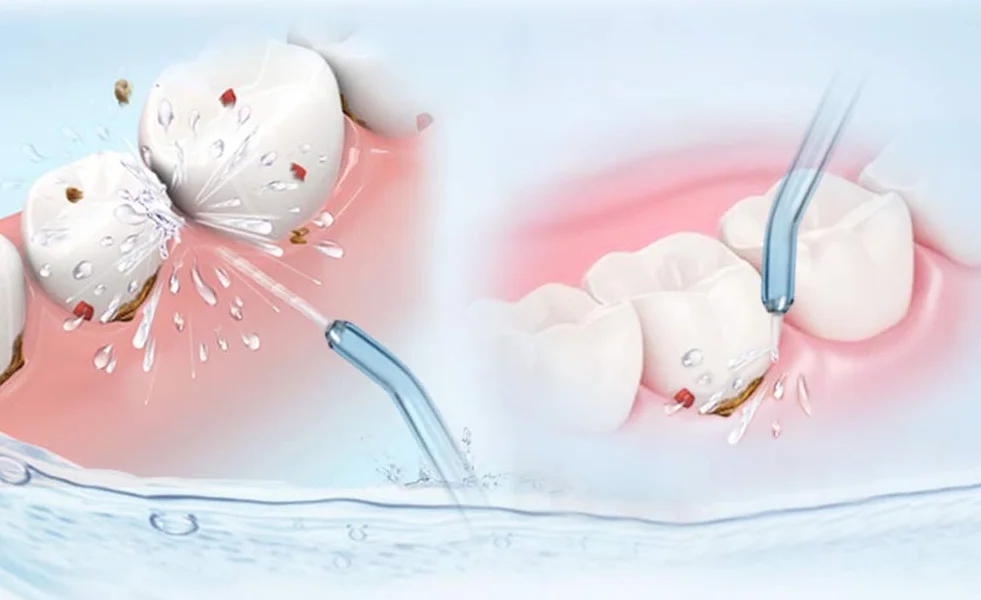YanBan Zamienne końcówki dysz do WaterPik Flosser WP-100 WP-450 WP-250 WP-300 WP-660 WP-900 (2 szt.)
