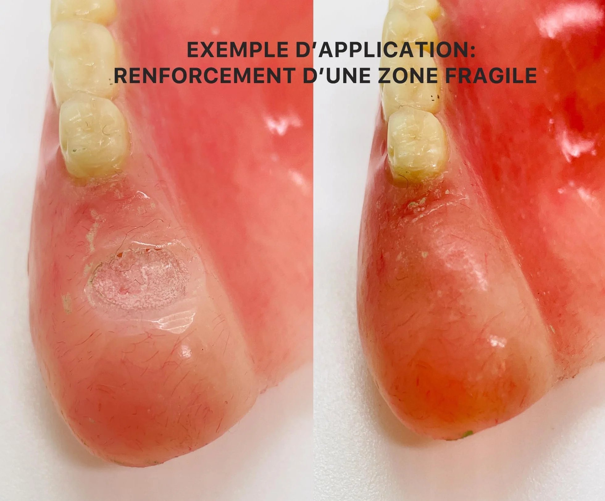 RÓŻOWA ŻYWICA DENTALNA - naprawa protez - zepsute protezy - luźne zęby